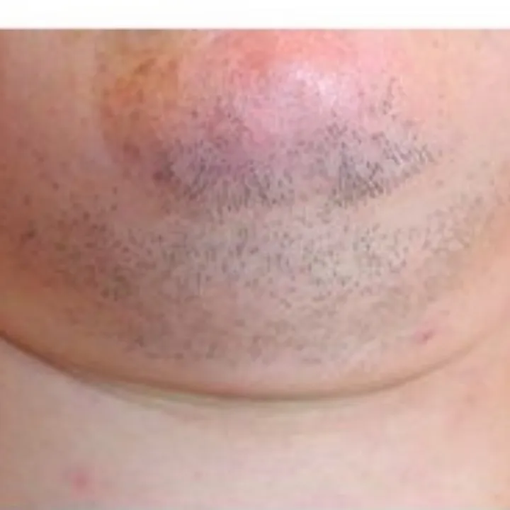easybeauty_kosmetikstudio_rielasingen_dauerhafte_haarentfernung_frau10