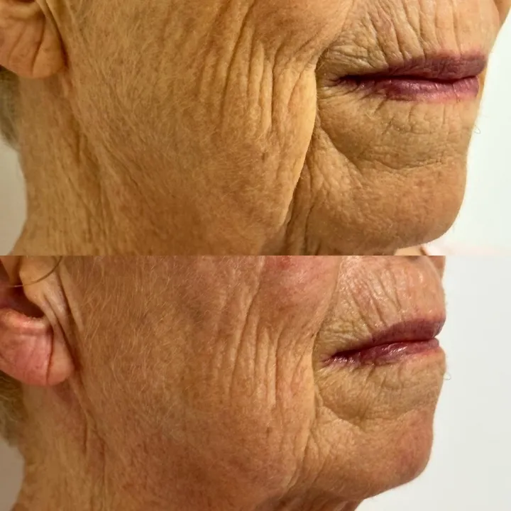 easybeauty_kosmetikstudio_thermo_line_pro_gesicht_hals_hautstraffung1