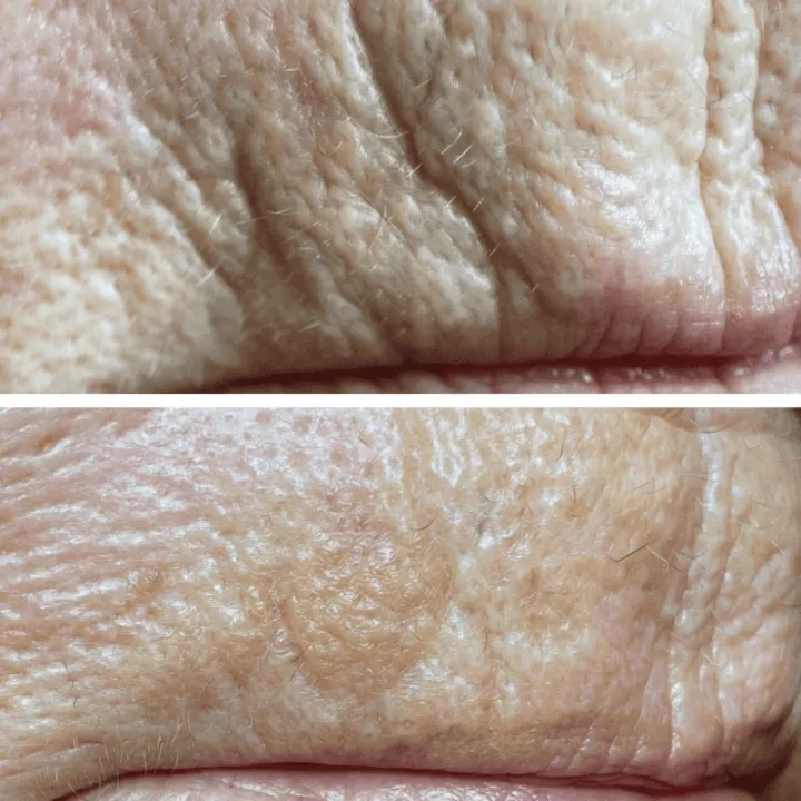 easybeauty_kosmetikstudio_thermo_line_pro_gesicht_hals_hautstraffung25