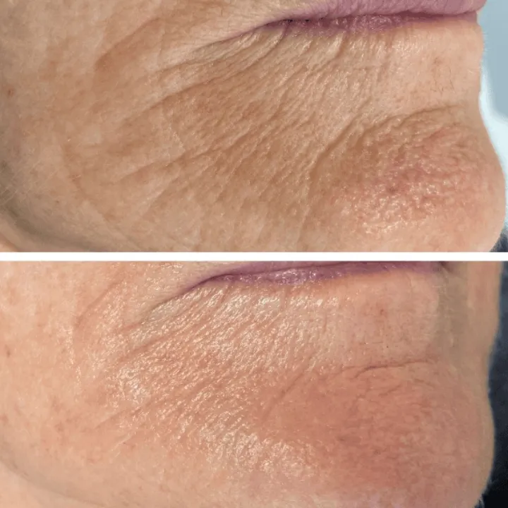easybeauty_kosmetikstudio_thermo_line_pro_gesicht_hals_hautstraffung27
