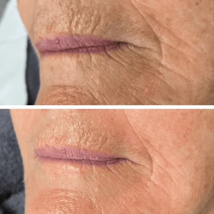 easybeauty_kosmetikstudio_thermo_line_pro_gesicht_hals_hautstraffung28