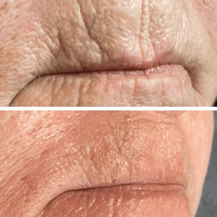 easybeauty_kosmetikstudio_thermo_line_pro_gesicht_hals_hautstraffung29