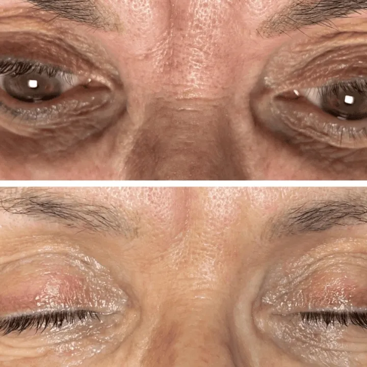 easybeauty_kosmetikstudio_thermo_line_pro_gesicht_hals_hautstraffung31
