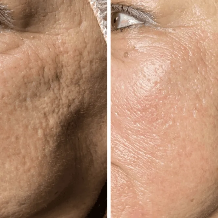 easybeauty_kosmetikstudio_thermo_line_pro_gesicht_hals_hautstraffung33