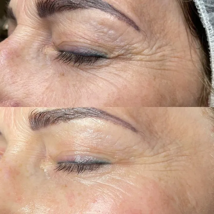 easybeauty_kosmetikstudio_thermo_line_pro_gesicht_hals_hautstraffung38