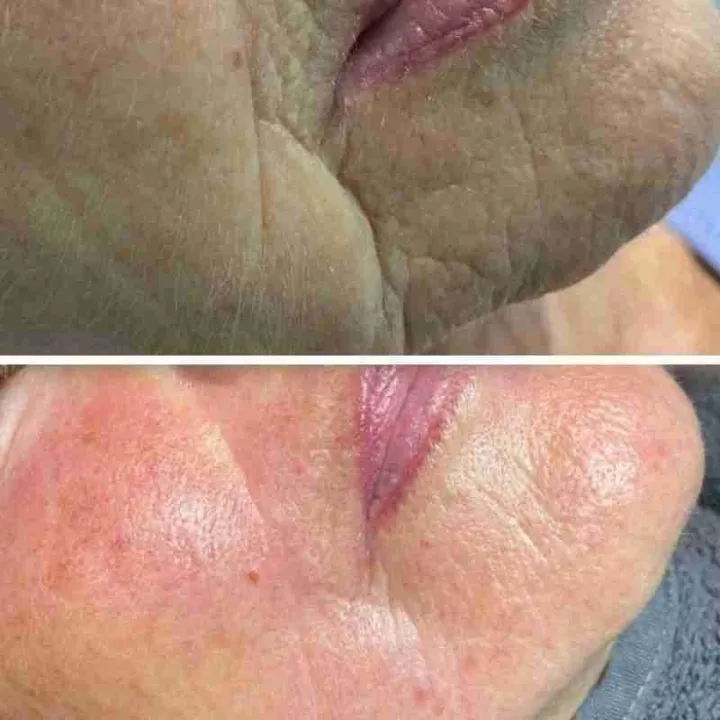 easybeauty_kosmetikstudio_thermo_line_pro_gesicht_hals_hautstraffung39