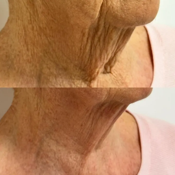 easybeauty_kosmetikstudio_thermo_line_pro_gesicht_hals_hautstraffung4