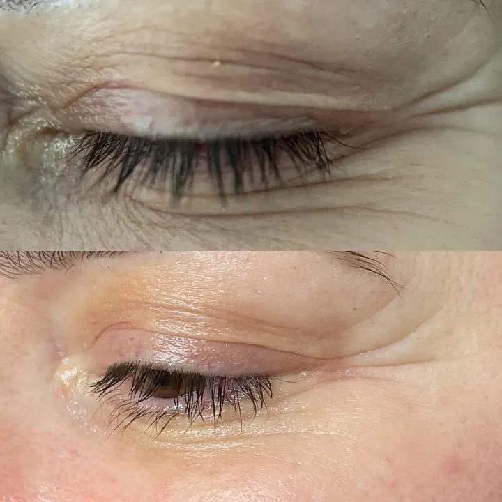 easybeauty_kosmetikstudio_thermo_line_pro_gesicht_hals_hautstraffung41