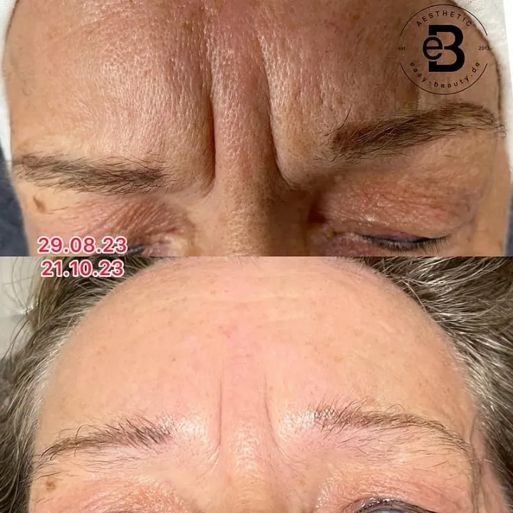 easybeauty_kosmetikstudio_thermo_line_pro_gesicht_hals_hautstraffung42