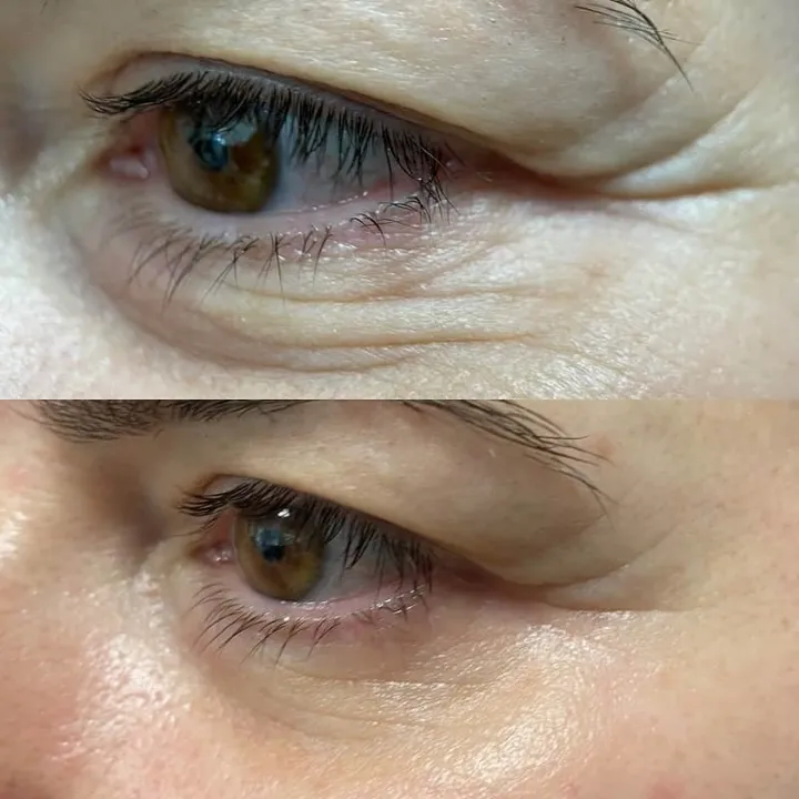 easybeauty_kosmetikstudio_thermo_line_pro_gesicht_hals_hautstraffung44