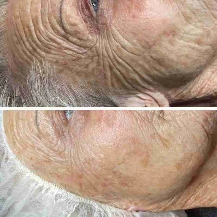 easybeauty_kosmetikstudio_thermo_line_pro_gesicht_hals_hautstraffung6