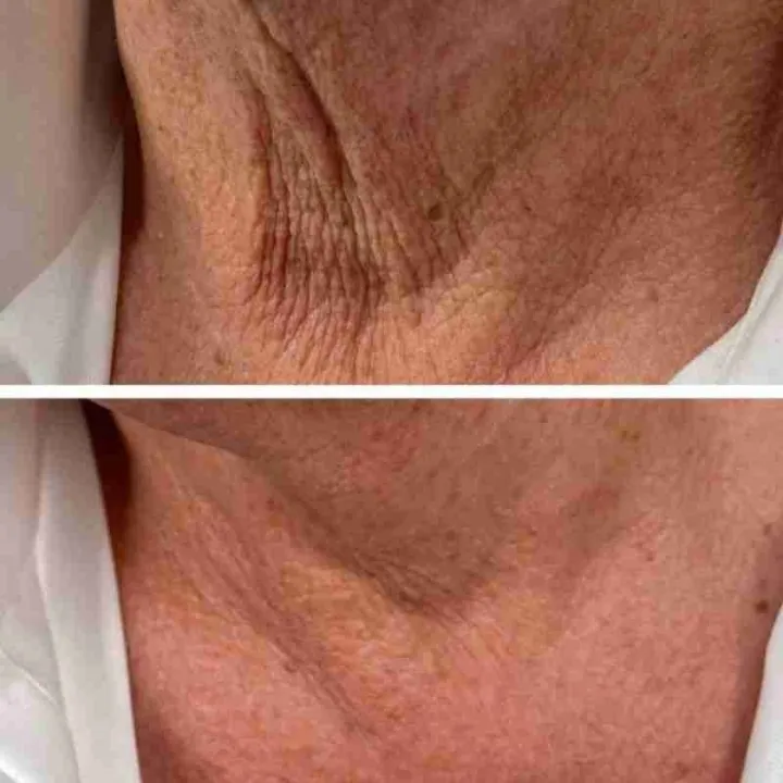 easybeauty_kosmetikstudio_thermo_line_pro_gesicht_hals_hautstraffung7