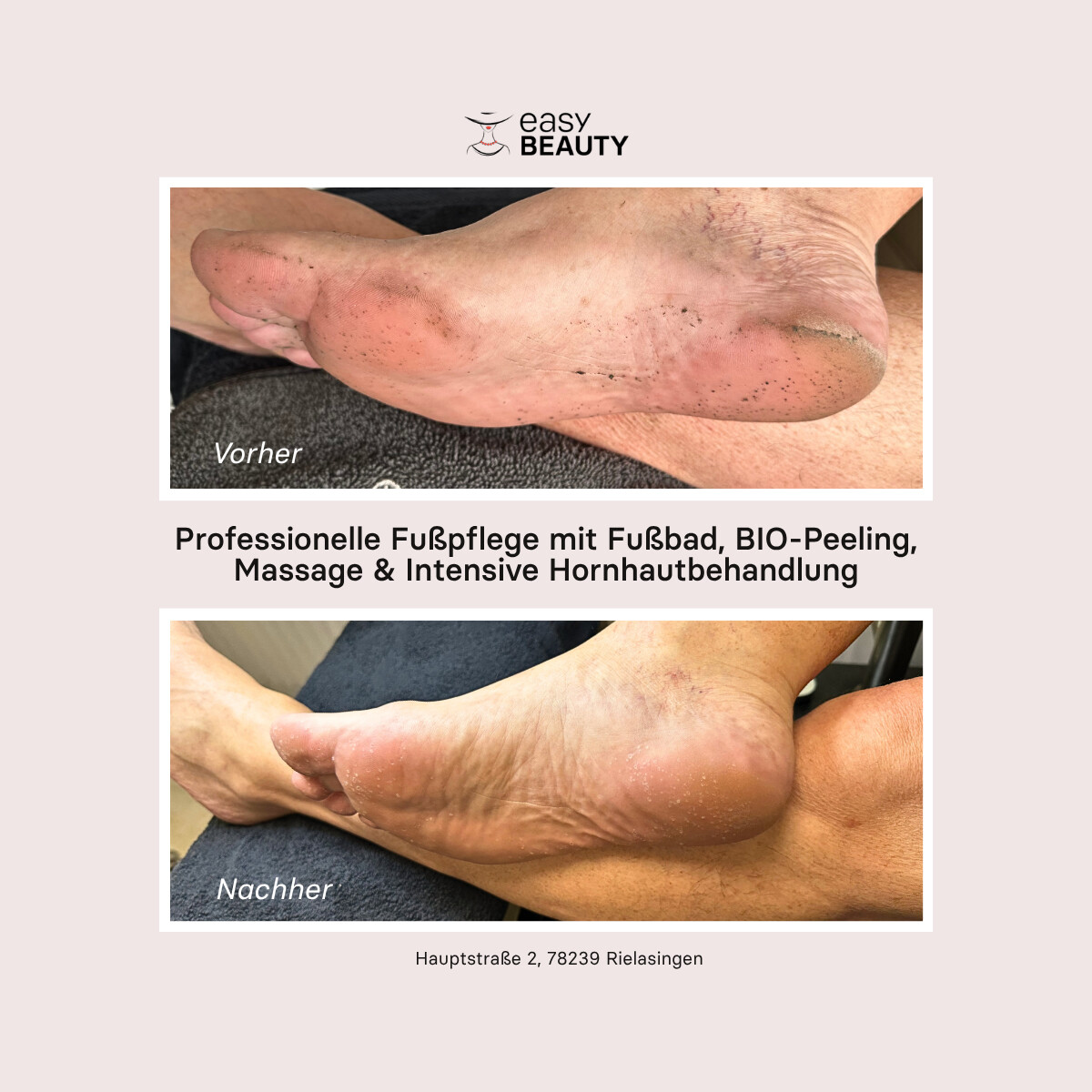 Vorher-Nachher: professionelle Fußpflege mit Hornhautbehandlung bei Easy Beauty Rielasingen bei Singen