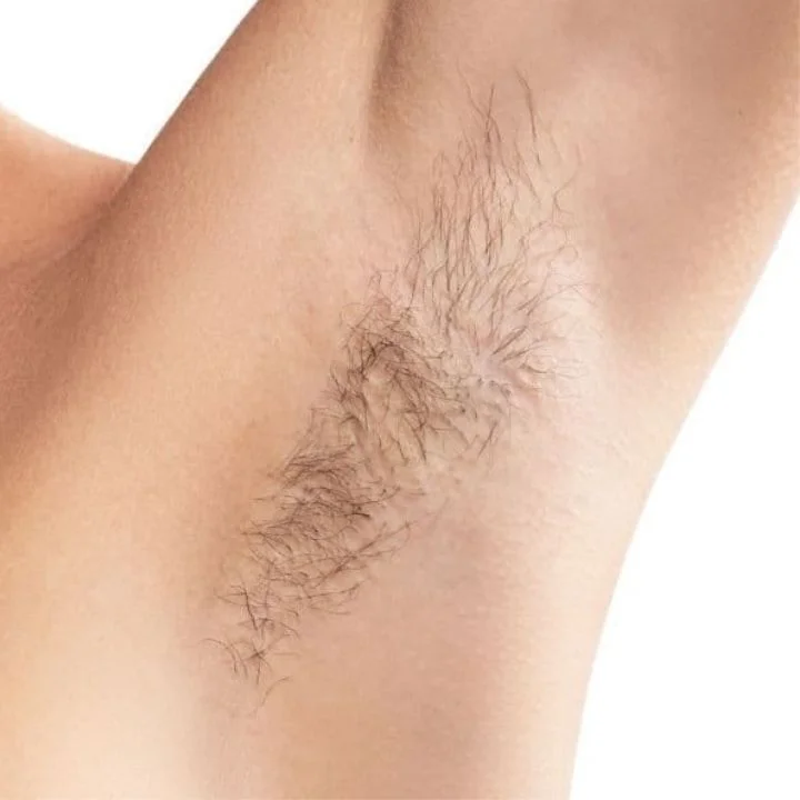 Achselbereich mit feinem Haarwuchs vor der Laser-Behandlung