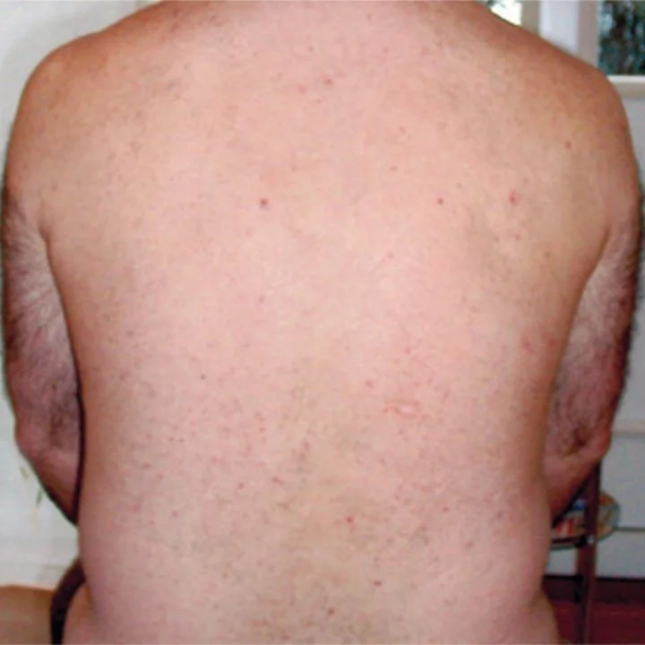 Glatter Rücken nach erfolgreicher Laser-Haarentfernung im Easy Beauty Studio