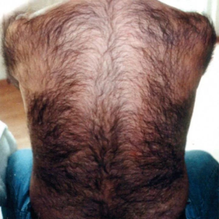 Rücken mit Haarwuchs vor professioneller Laser-Haarentfernung